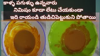 కాళ్ళ పగుళ్లు వెంటనే పోవాలంటే//క్రాక్ Heels Remedy....