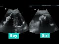 ultrasound showing a boy and a girl baby both at 29 weeks