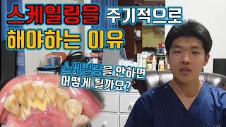 스케일링을 주기적으로 해야하는 이유ㅣ스케일링을 안하면 어떻게 될까요?ㅣ치과의사 웅's 스케일링 총정리