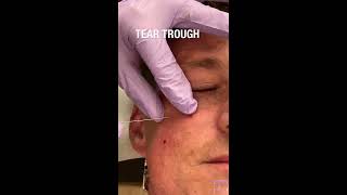 Male Facial Sculpting: Tear Trough and Medial Cheek