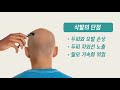 탈모q u0026a 삭발을 하면 모발이 굵어지나요