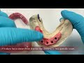 the process of a full mouth hybrid zirconia