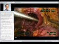 SAGES Resident Webinar: Advanced Laparoscopic Foregut Surgery: Tips and Tricks