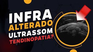 Tendão do Infraespinhal Alterado? Como avaliar no ULTRASSOM? | Caso 010 - MSKD