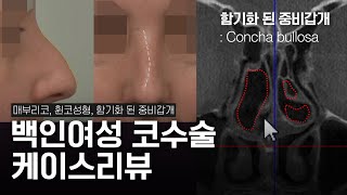 매부리코, 휜코 교정외국인(서양인) 코성형 수술전후 1달 | 백인여성 코성형 CT영상 有