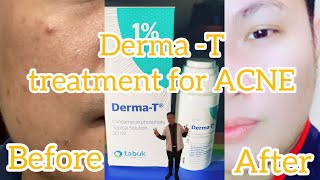 Derma T  solution for ACNE