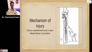 NMOACON 2023 : Comminuted Radial Head Fractures Preserve \u0026 Wait - Dr. Dharmaraj Yadav