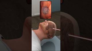 ব্রেন টিউমার সার্জারি যেভাবে করা হয় 😱 | how brain tumor is treated (3D Animation) #shorts #ytshorts