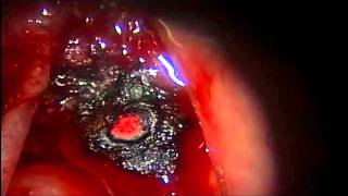 ELM LASER FOR LARYNGEAL PAPILLOMA, Dr Ken Liao LIU 喉部顯微內視鏡雷射手術 治療喉部聲帶乳突瘤