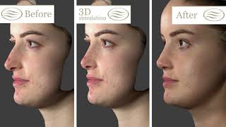 Rhinoplasty - before / 3D simulation / After