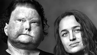 Face Transplant Patient and Wife-Joe and Jessica Dimeo (2026 Update)