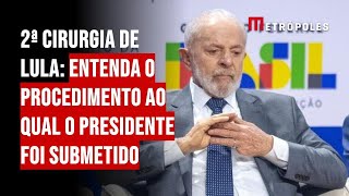 2ª cirurgia de Lula: entenda o procedimento ao qual o presidente foi submetido