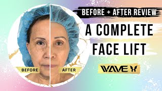 SMAS Facelift Before and After: Amazing Full Face Transformation | Wave Plastic Surgery