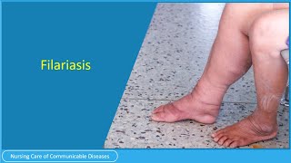 Filariasis