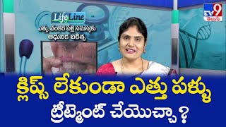 క్లిప్స్ లేకుండా ఎత్తు పళ్ళు ట్రీట్మెంట్ చేయొచ్చా ?