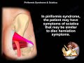 Piriformis Syndrome & Sciatica - Everything You Need To Know - Dr. Nabil Ebraheim