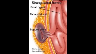 Strangulated hernia symptoms