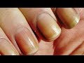 നഖത്തിന്റെ cancer ലക്ഷണങ്ങൾ symptoms and causes of nail cancer health care tips