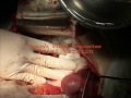 perclot liver surgery video hr ml0460 000