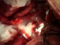 perclot liver surgery video hr ml0460 000