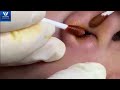 acne in nose full video hhv clinic