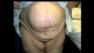 Ventral Hernia in the Morbidly Obese Patient: Yuri Novitsky, M.D.