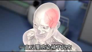 男頭骨破7年 3D列印重建--蘋果日報20160508