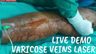 Laser Treatment for Varicose Veins | Varicose veins Laser treatment Live | live EVLT surgery