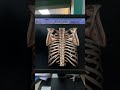 3D Ribs Cage/Bones 3D Reconstruction of Chest