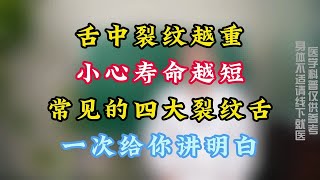 舌中裂纹越重，小心寿命越短！常见的4大裂纹舌，一次给你讲明白