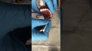 How to apply Povidone Iodine to teeth