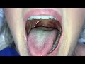 evaluation of compensation patterns for patients with posterior tongue tie.