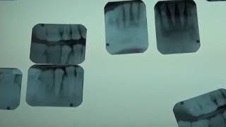 DATV- Mounting XRays