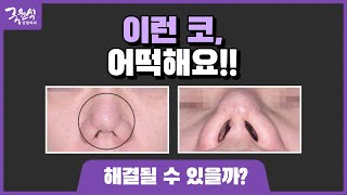 이런 코도 수술로 해결 가능할까? ㅣ 이런 코는 수술하지 마세요!