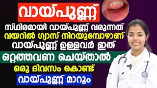 സ്ഥിരമായി വായ്പുണ്ണ് വരുന്ന ആളാണോ നിങ്ങൾ?എങ്കിൽ വയറ്റിൽ ഗ്യാസ് നിറഞ്ഞിട്ടാണ് | ഒറ്റത്തവണ ഇത് ചെയ്യൂ