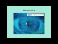 photokeratitis crash medical review series