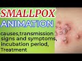 Smallpox symptoms | smallpox treatment | small pox | smallpox animation | smallpox virus | 3D