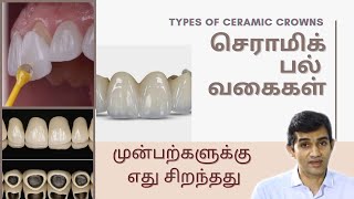 செராமிக் பல் வகைகள் | முன்பற்களுக்கு எது சிறந்தது | Types of Ceramic Crowns | Dr Arunkumar | Chennai