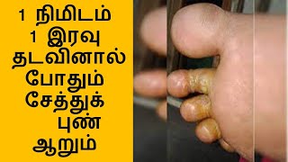 சேற்றுப்புண் குணமாக என்ன செய்ய வேண்டும்| setru pun marunthu|athlete’s foot treatment