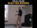 injection wounds