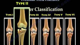 Tibial Plateau Fractures Proximal Tibia Fractures - Everything You Need To Know - Dr. Nabil Ebraheim