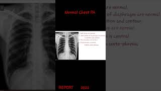 X-Ray Chest PA NORMAL REPORT