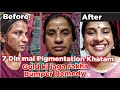 7 Din main Pigmentation Khatam | Bumper Remedy ka ek aur chamatkar