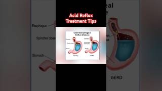 🔥😷 Acid Reflux Treatment Tips #acidreflux #gerd #heartburn #shorts