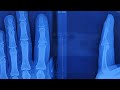 Finger fracture ( malunion)#fingerinjury, #fingerfracture #fracture