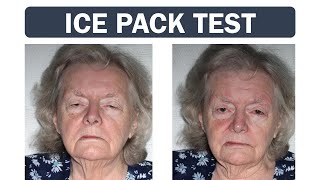 Ice Pack Test for Myasthenia Gravis