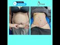 Extended Tummy Tuck Surgery Result | Extended Tummy tuck immediate before & after