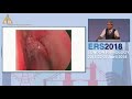 ers london 2018 the role of surgery in olfactory dysfunction does it really work simon gane