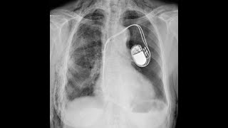 Viața cu stimulator cardiac (pacemaker). Răspunsuri la cele mai frecvente întrebări.