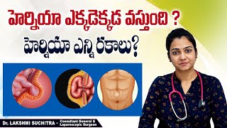 ఈ లక్షణాలుంటే జాగ్రత్త || Types and Locations Of Hernia In Telugu || Sankhya Hospitals